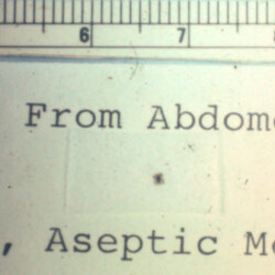 tick-removed-from-abdomen-multiple-em-and-aseptic-meningitis